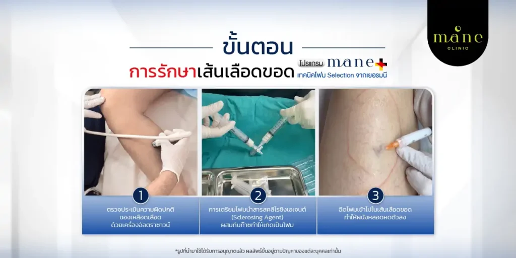 ขั้นตอนการรักษาเส้นเลือดขอด