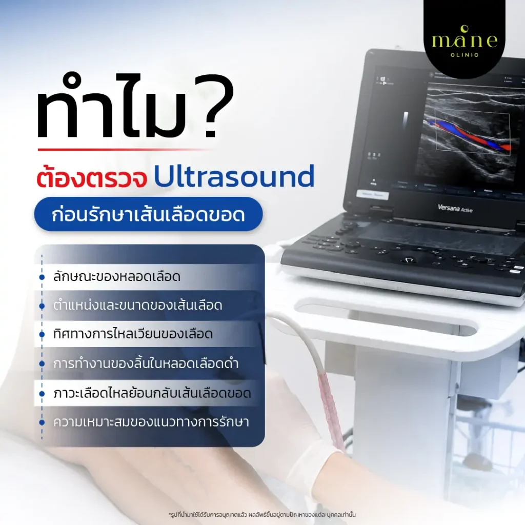 ทำไมต้องตรวจ Ultrasound ก่อนรักษาเส้นเลือดขอด?