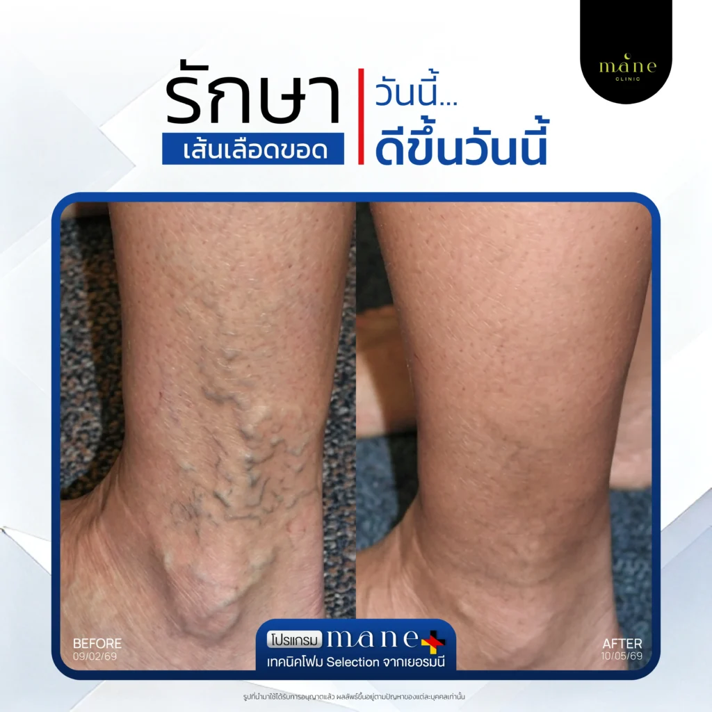 รักษาวันนี้ ดีขึ้นวันนี้