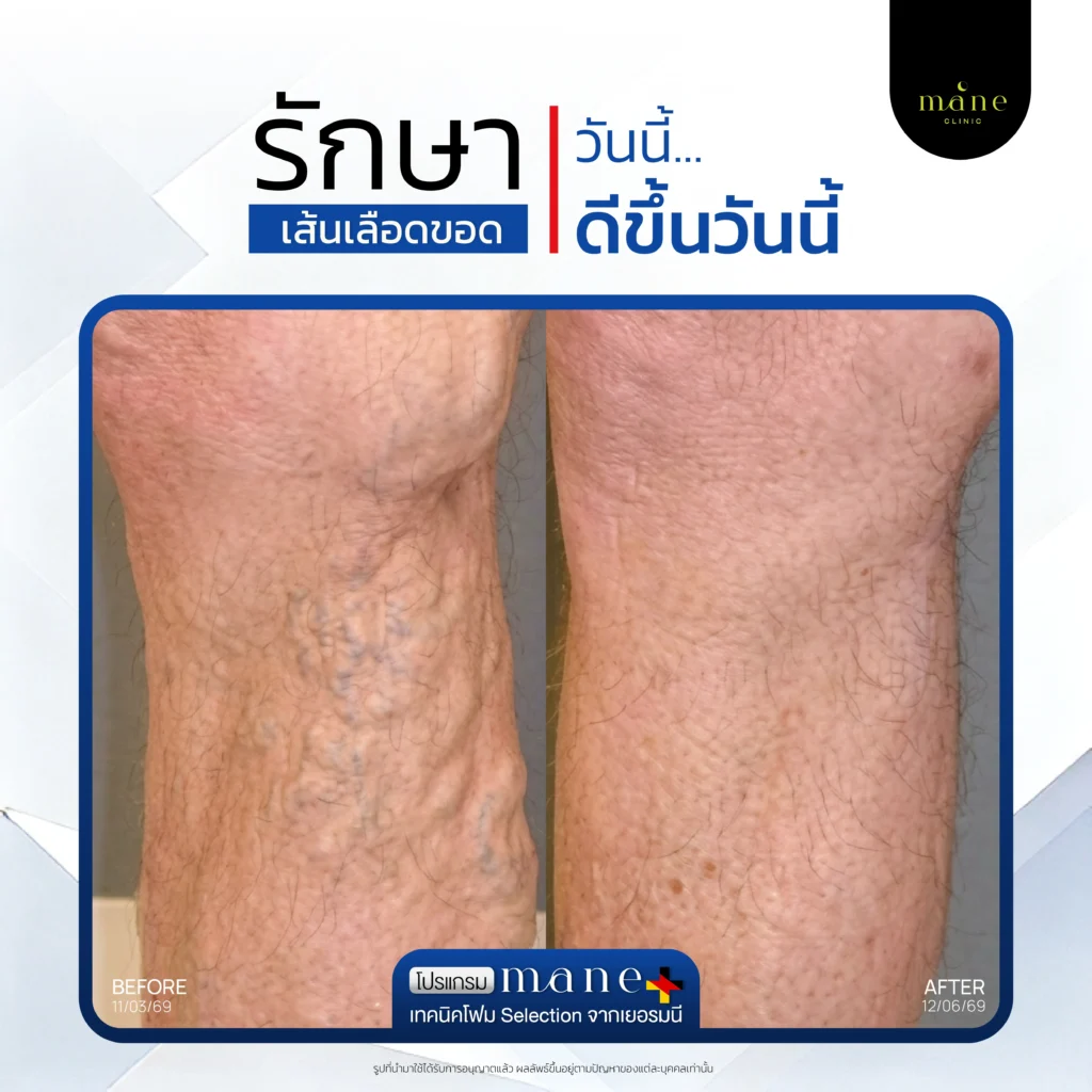 รักษาวันนี้ ดีขึ้นวันนี้