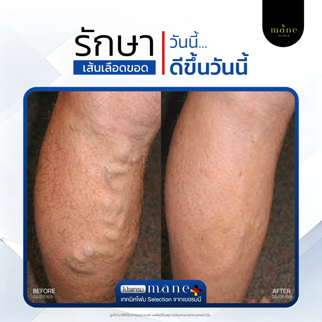 รักษาวันนี้ ดีขึ้นวันนี้