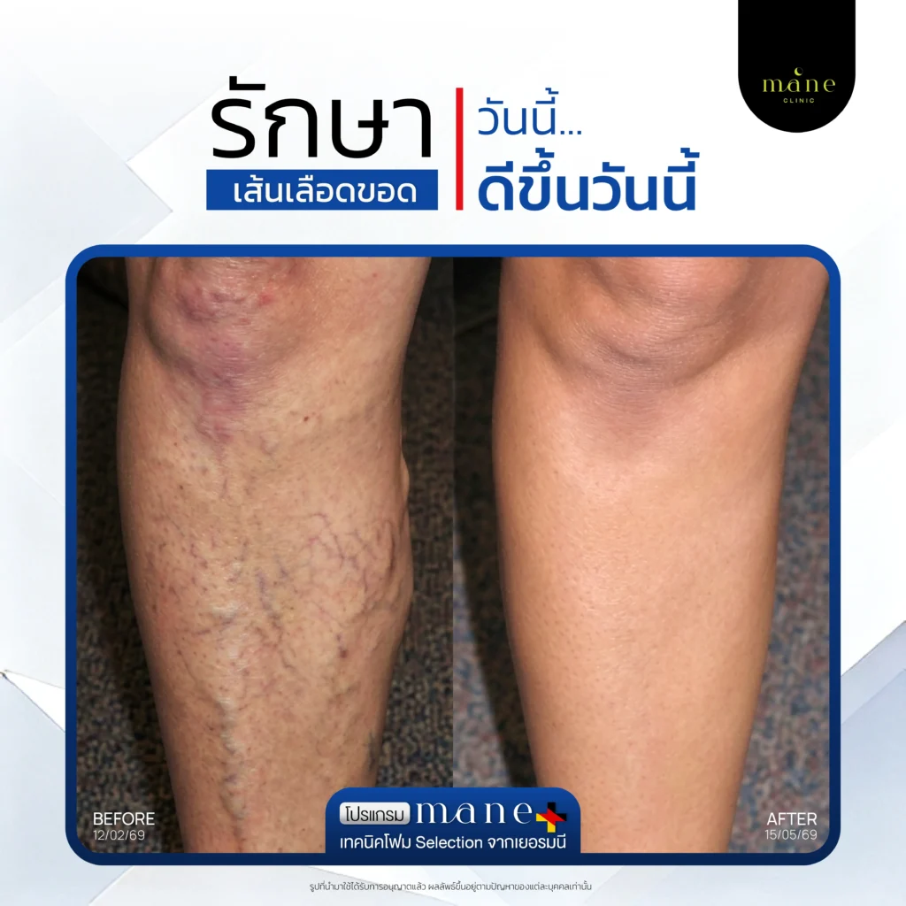 รักษาวันนี้ ดีขึ้นวันนี้
