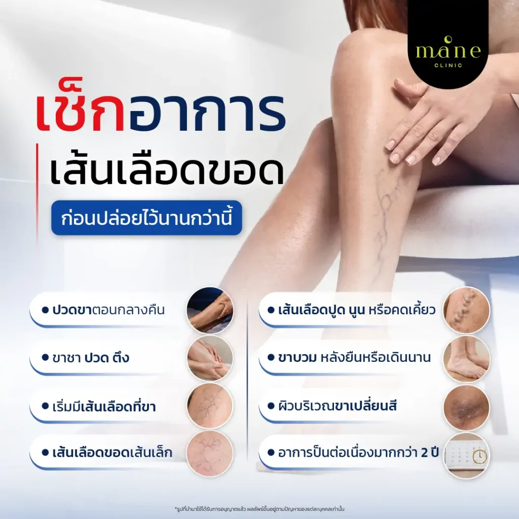 เช็กอาการเส้นเลือดขอด