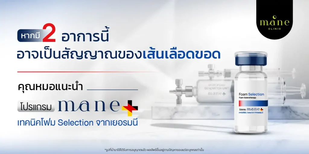 หากมี 2 อาการนี้อาจเป็นสัญญาณของเส้นเลือดขอด