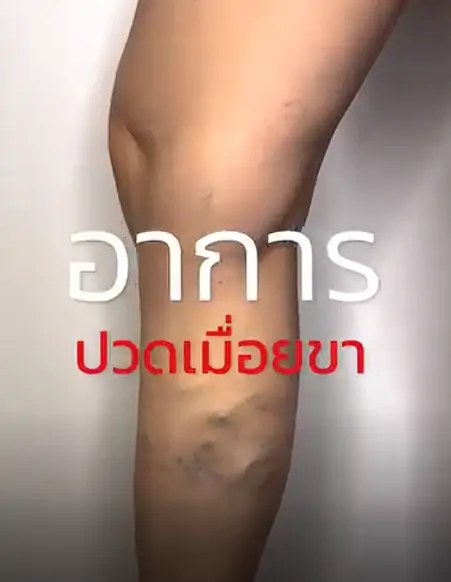 อาการปวดเมื่อยขา