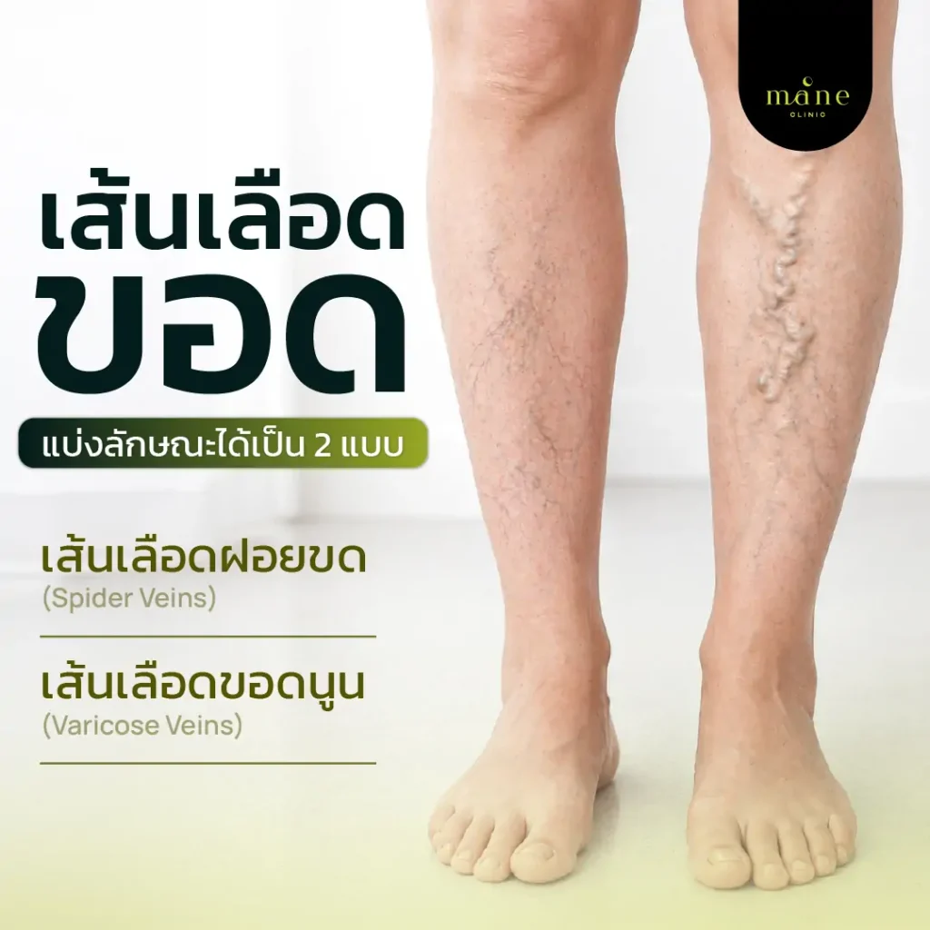 เส้นเลือดขอด
