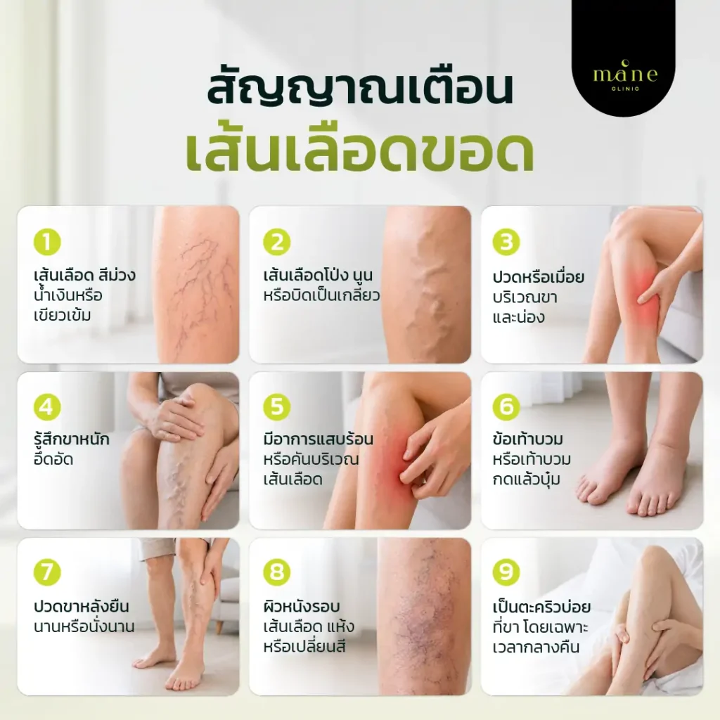 สัญญาณเตือนเส้นเลือดขอด