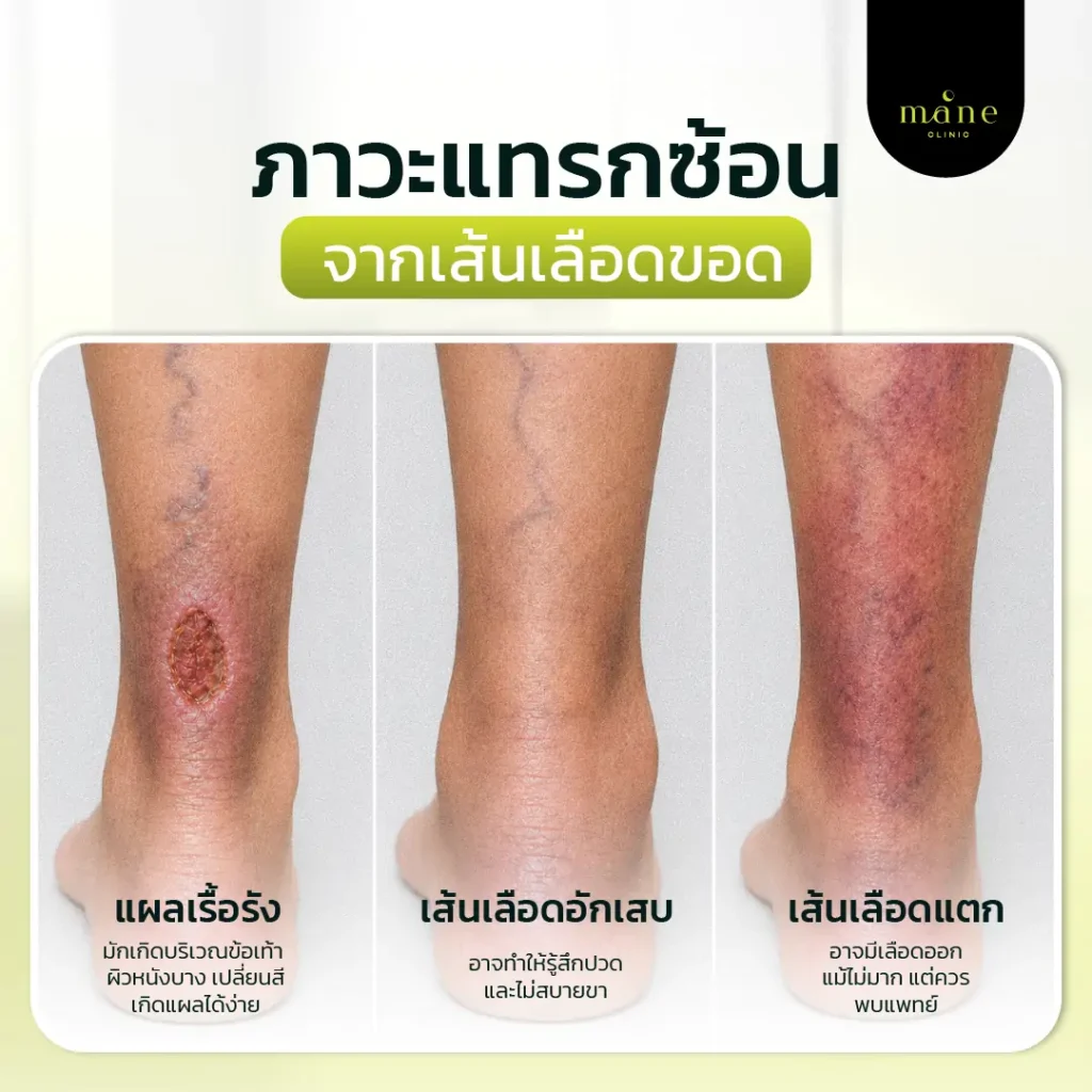 ภาวะแทรกซ้อนจากเส้นเลือดขอด