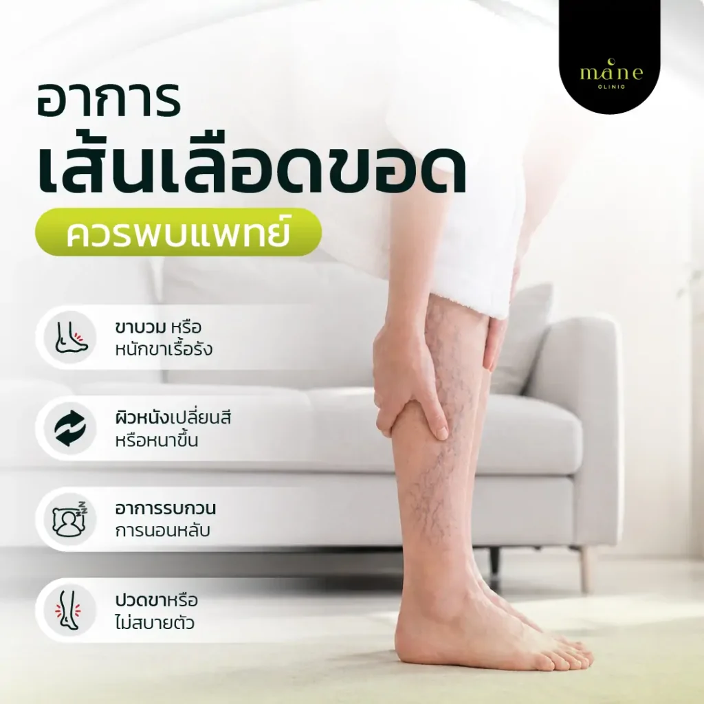 อาการเส้นเลือดขอด