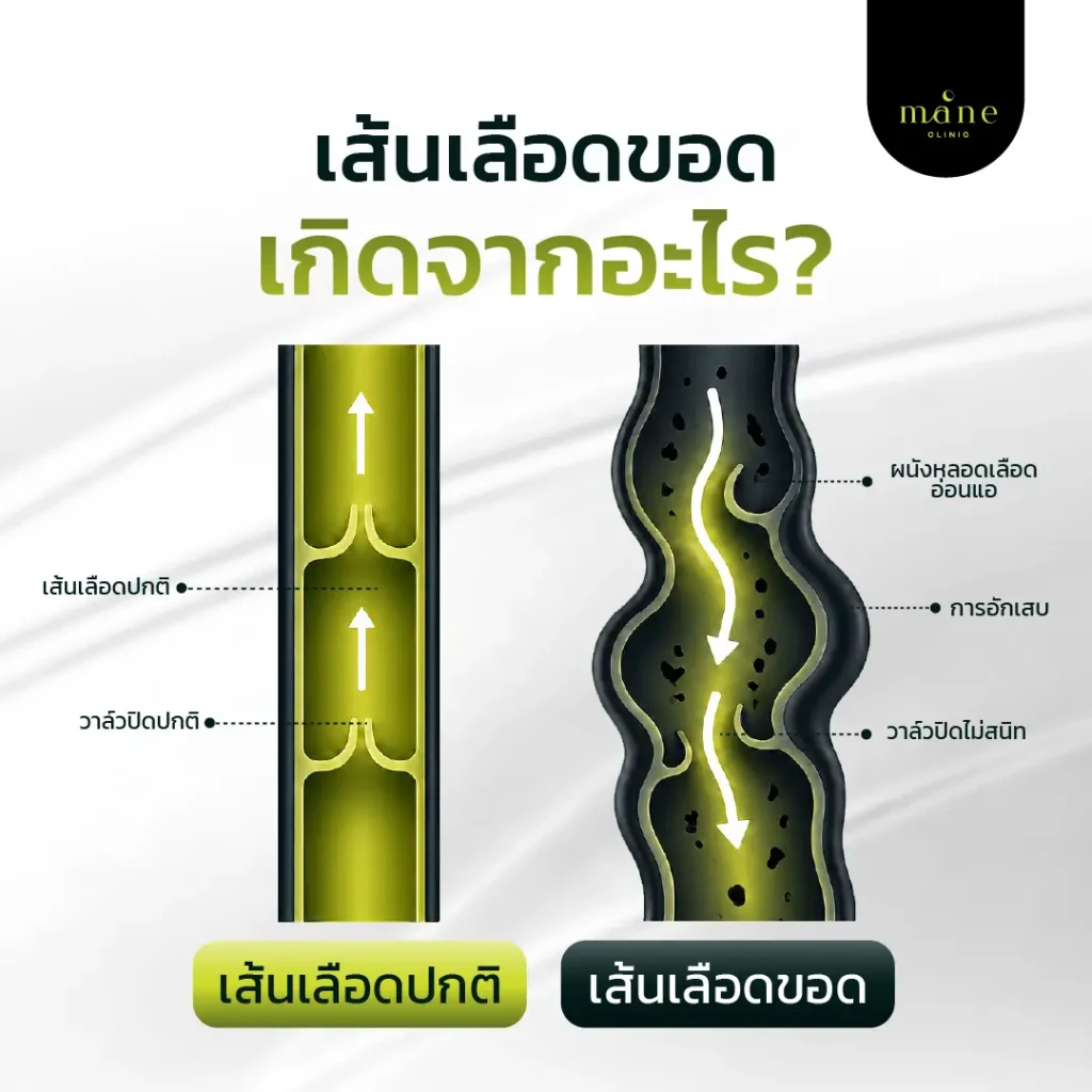 เส้นเลือดขอดเกิดจากอะไร