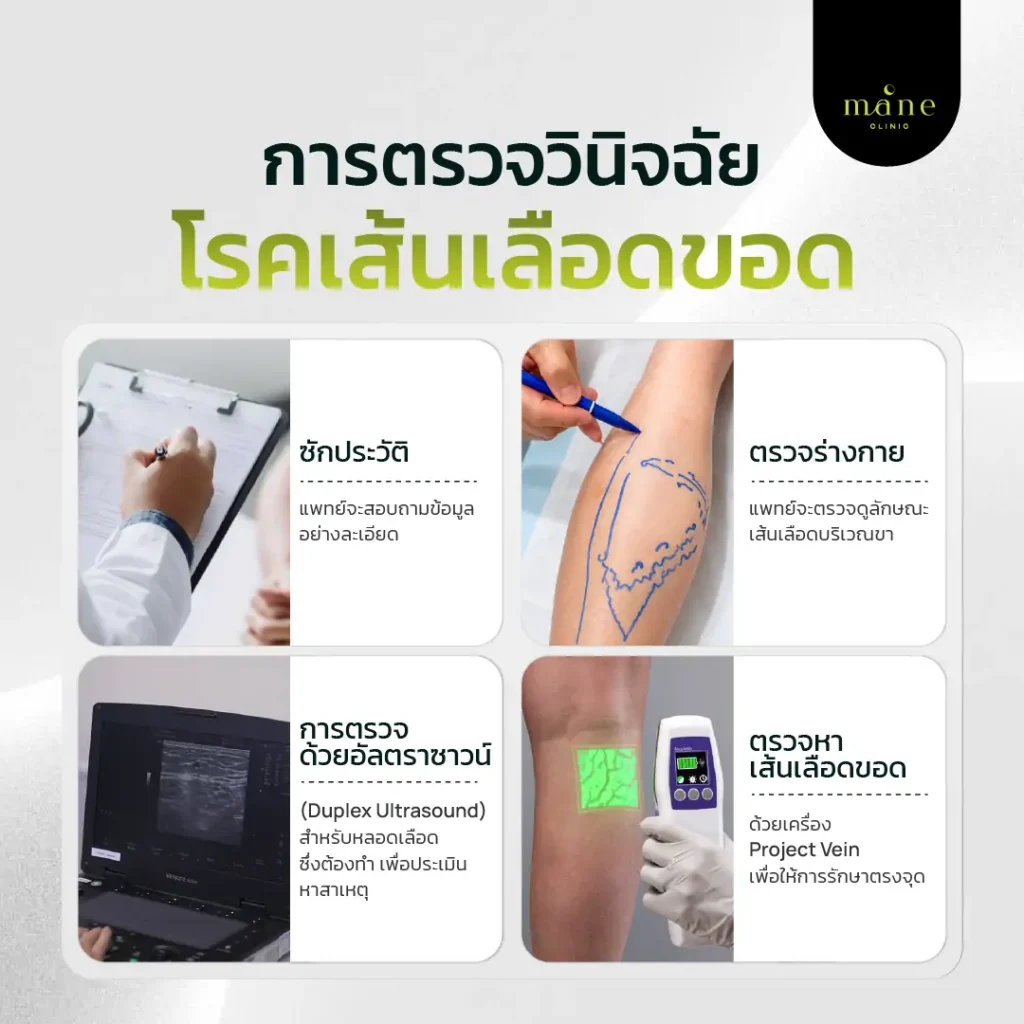 การตรวจวินิจฉัยเส้นเลือดขอด