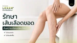 รักษาเส้นเลือดขอด โปรแกรม LEXZA PLUS