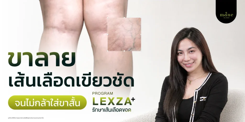 ขาลาย เส้นเลือดเขียวชัด จนไม่กล้าใส่ขาสั้น รีวิวรักษาเส้นเลือดขอด คุณจ๊ะโอ๋ | อาชีพนักแสดงอิสระ