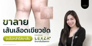 ขาลาย เส้นเลือดเขียวชัด จนไม่กล้าใส่ขาสั้น รีวิวรักษาเส้นเลือดขอด คุณจ๊ะโอ๋ | อาชีพนักแสดงอิสระ
