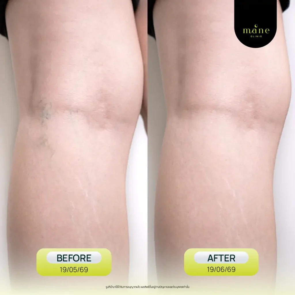 before after