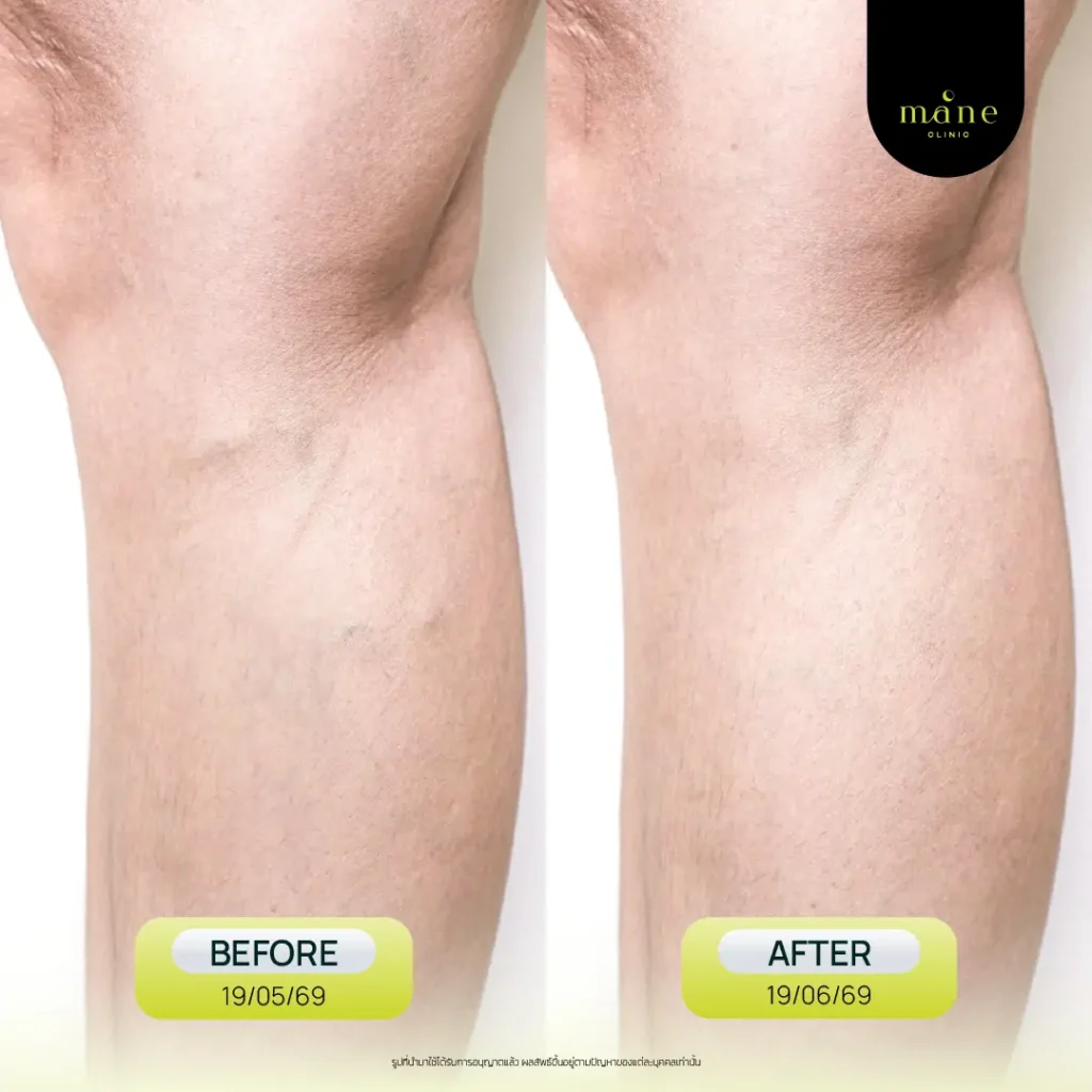before after