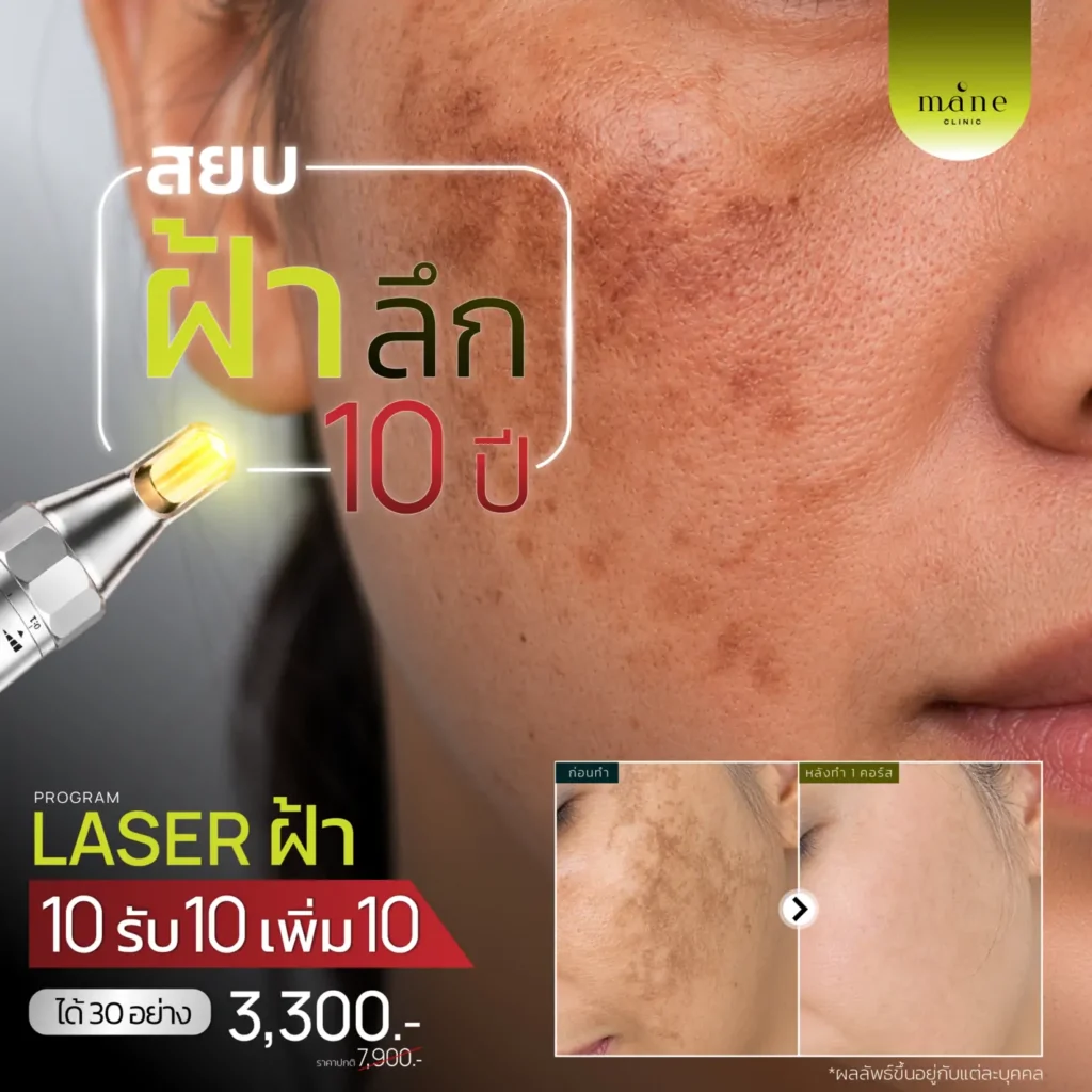 สยบฝ้าลึก 10 ปี