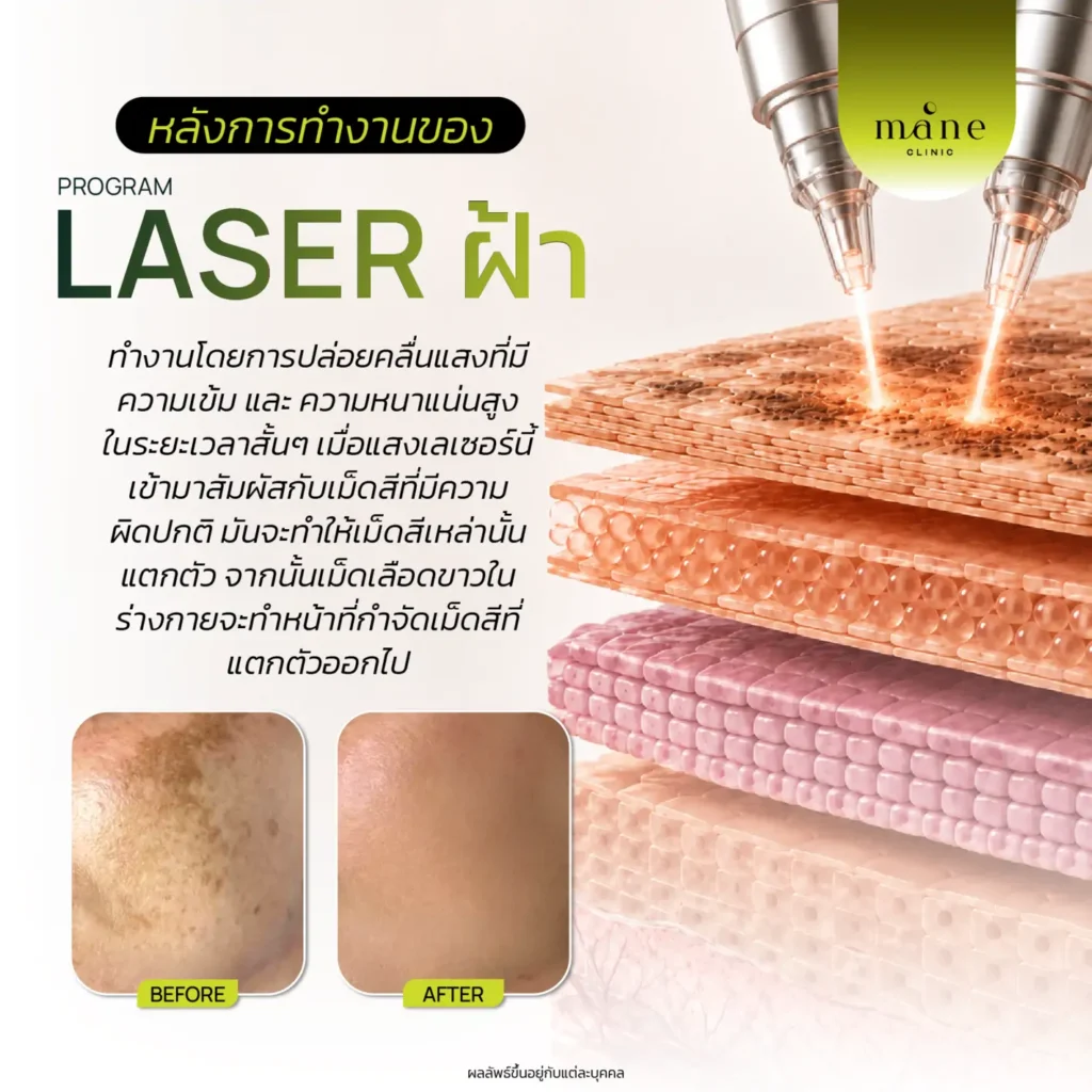 laser ฝ้า