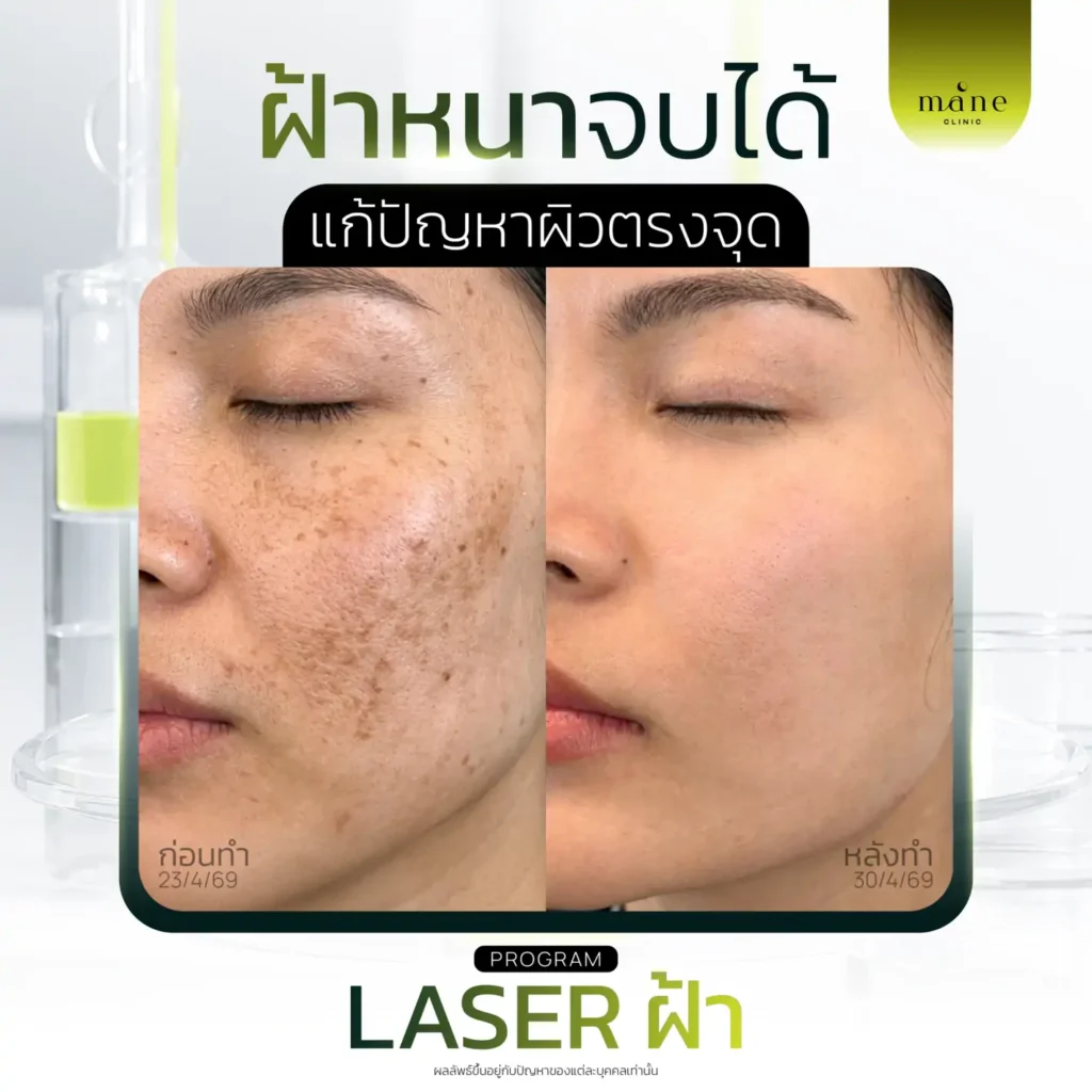 ฝ้าหนาจบได้