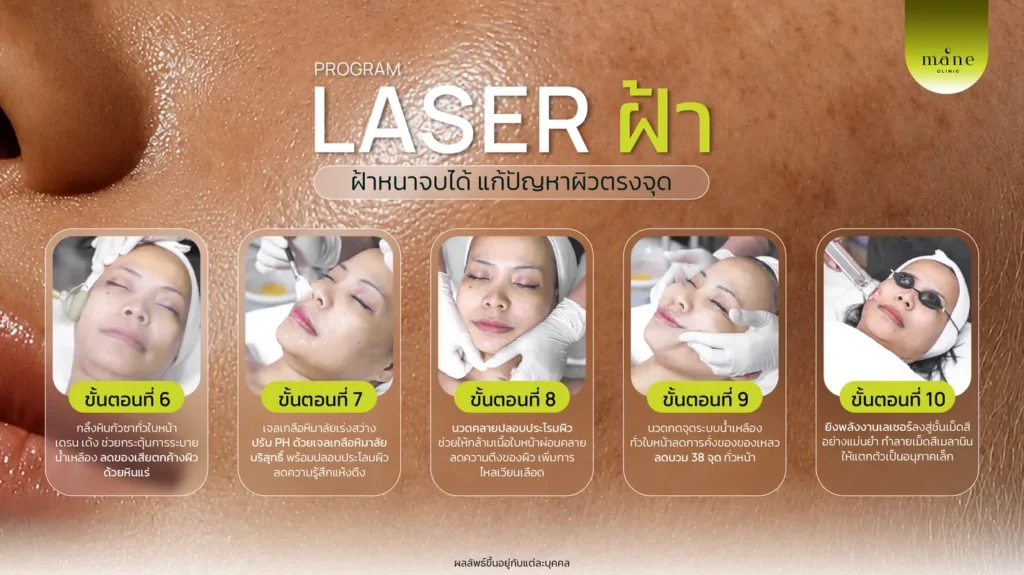 laser ฝ้า