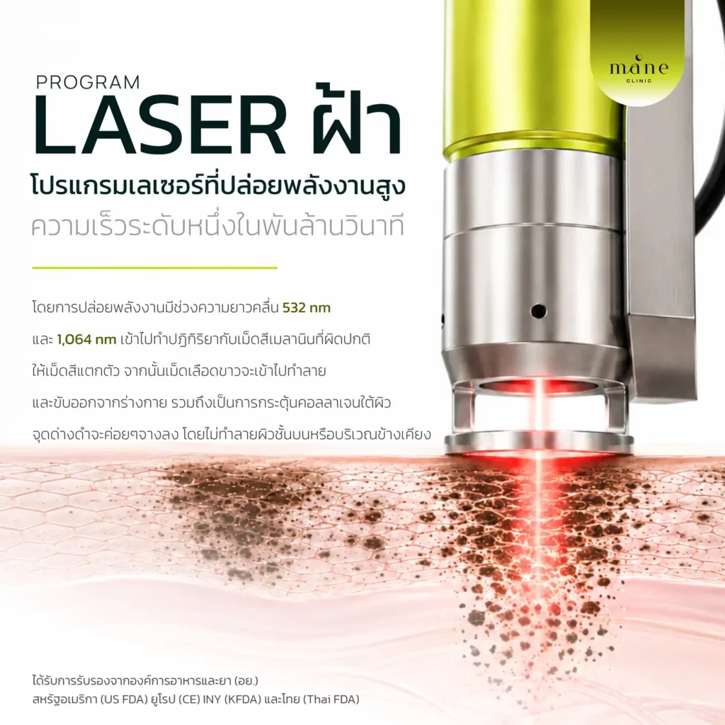 laser ฝ้า