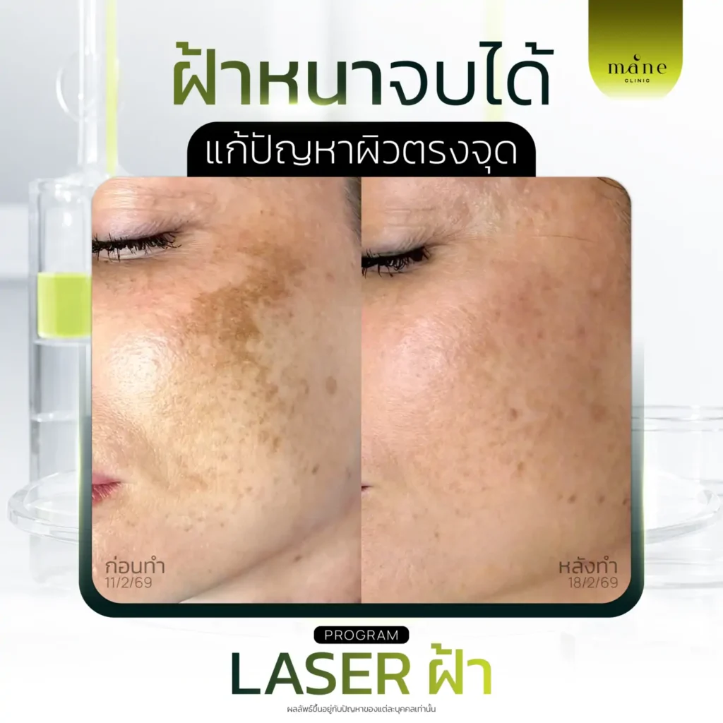 ฝ้าหนาจบได้
