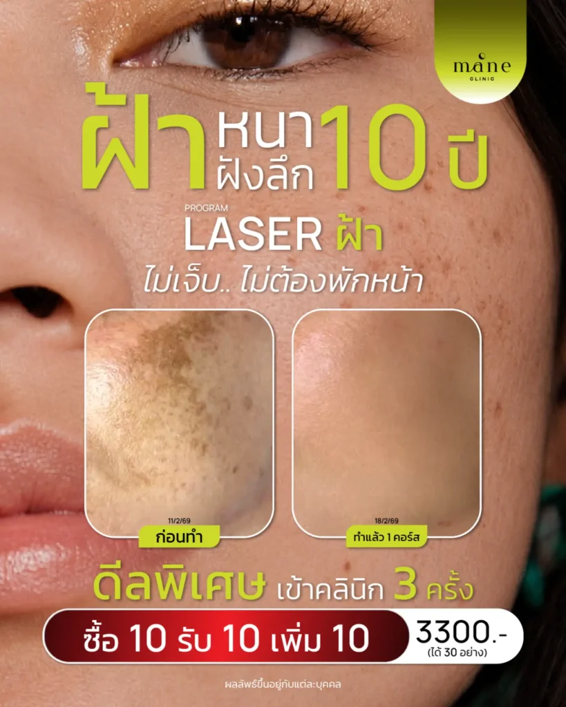 ฝ้าหนาฝังลึก 10 ปี