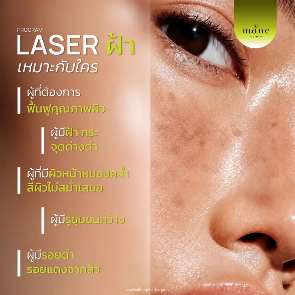 laser ฝ้า