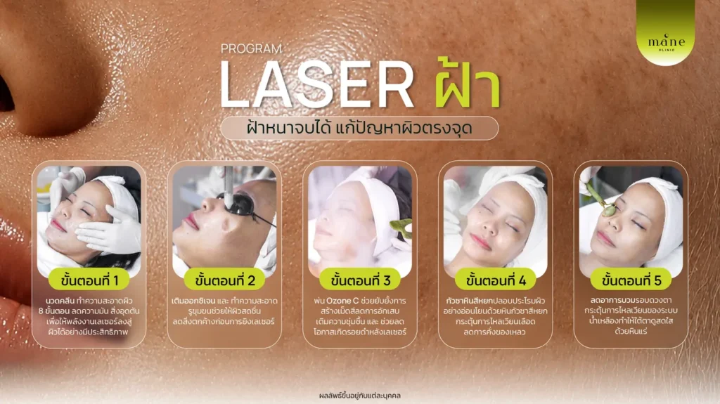 laser ฝ้า