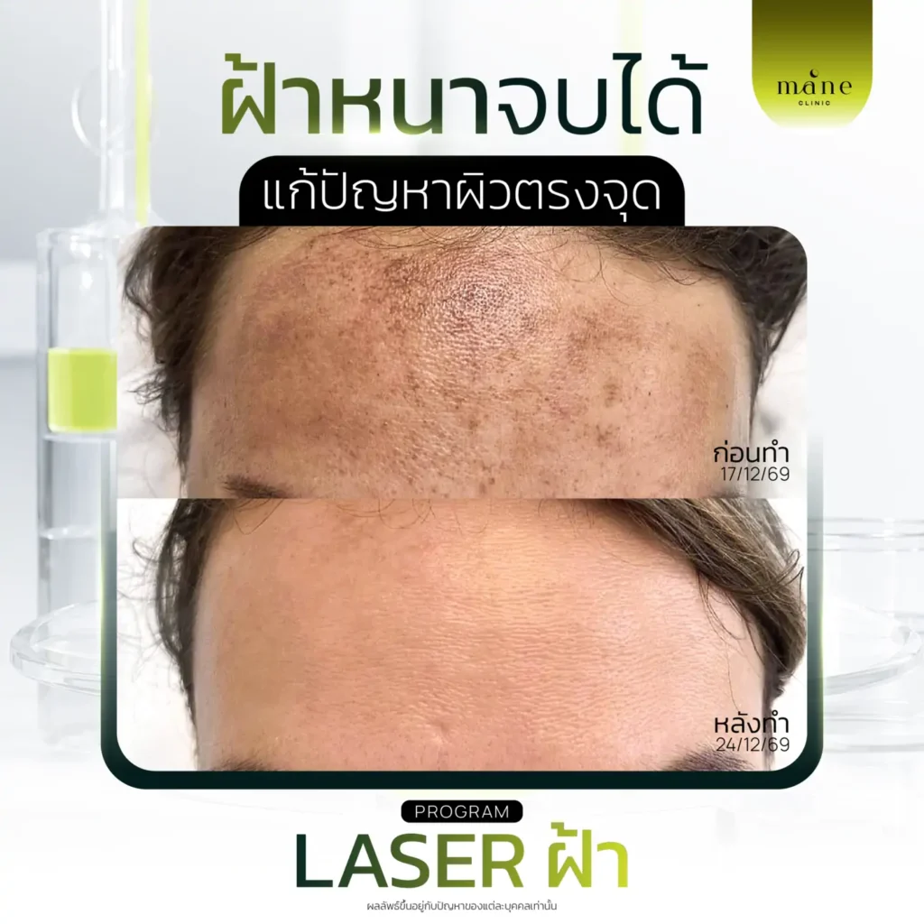 ฝ้าหนาจบได้