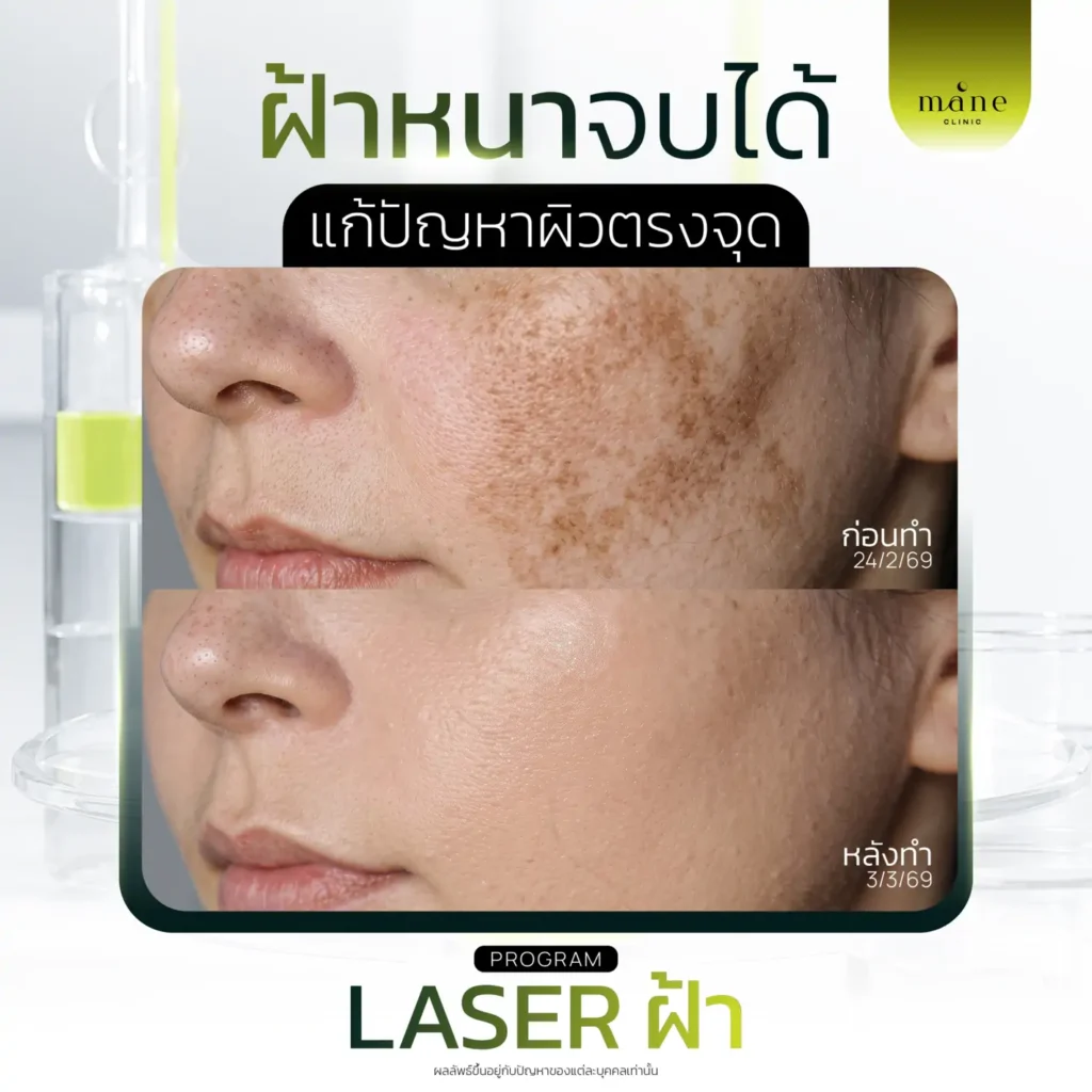 ฝ้าหนาจบได้