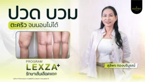 ปวด บวม เป็นตะคริวจนนอนไม่ได้ ตัดสินใจรักษาเส้นเลือดขอด โปรแกรม Lexza Plus