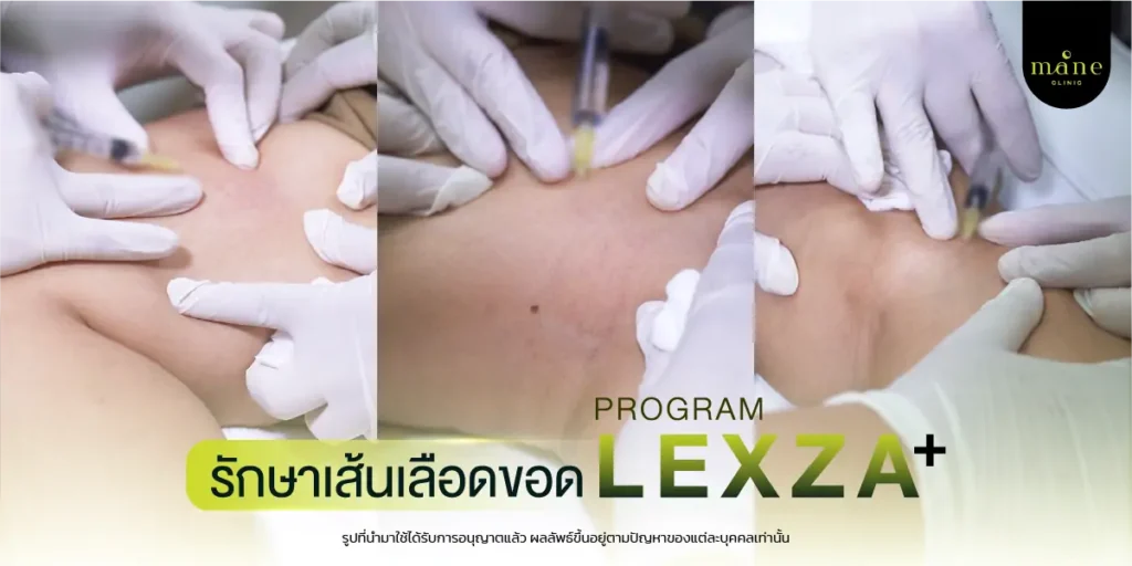 รักษาเส้นเลือดขอด