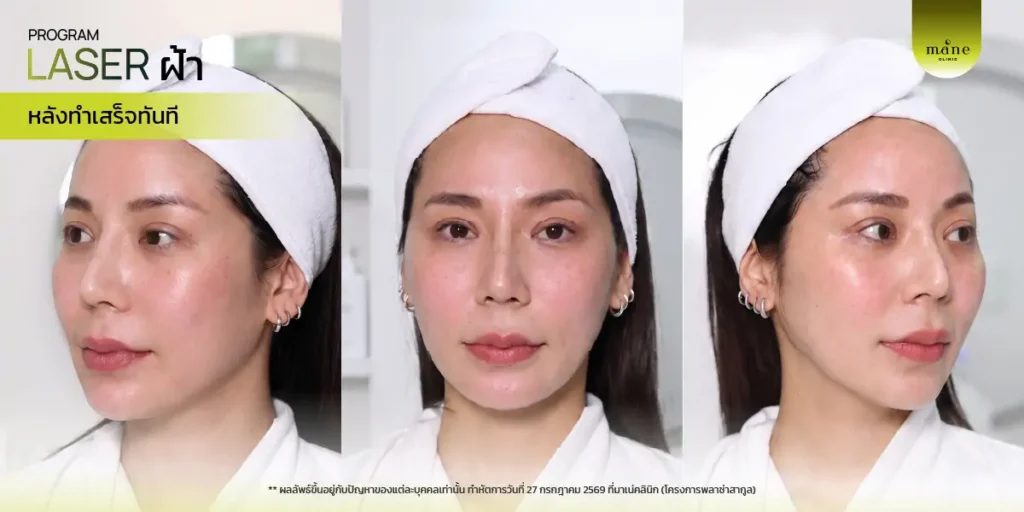 หลังทำเสร็จทันที