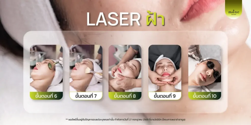 laser ฝ้า