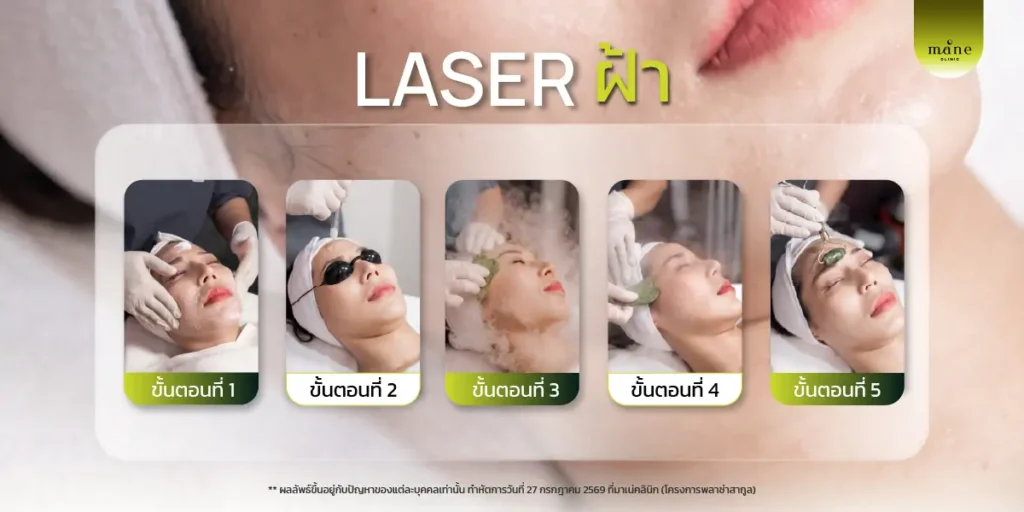 laser ฝ้า